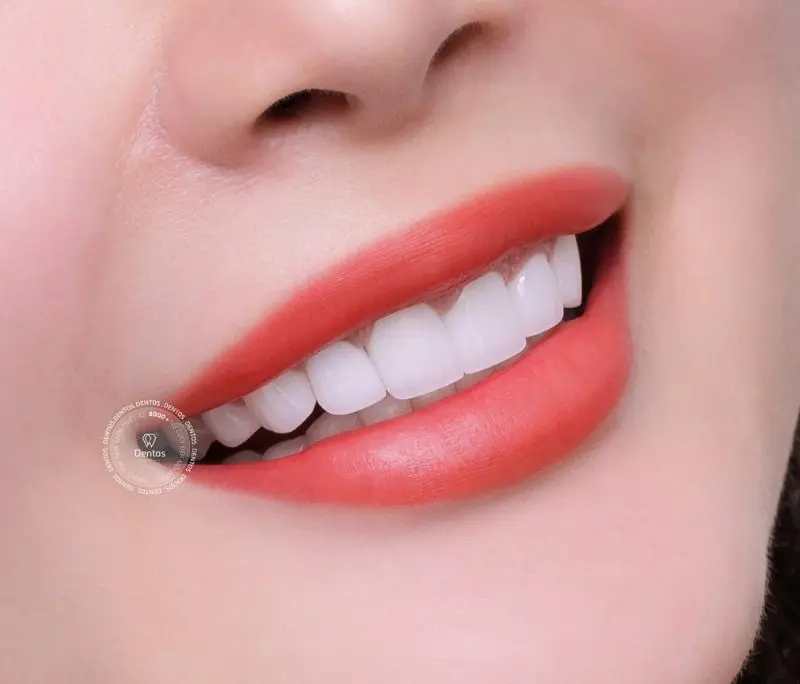 Răng sứ Zirconia có màu sắc trắng trong, độ mờ và khả năng phản quang như răng thật